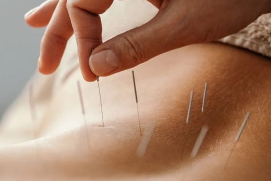 Acupressure / Acupuncture