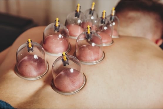 Cupping Therapy