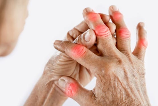 Rheumatoid Arthritis